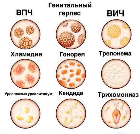 Симптомы бактериальных ЗППП: сифилиса и венерического лимфогранулематоза