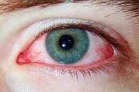 Основные симптомы перенапряжения глаза: