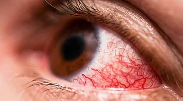 Перенапряжение глаз: причины и симптомы