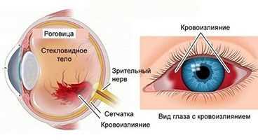 Симптомы перенапряжения глаза