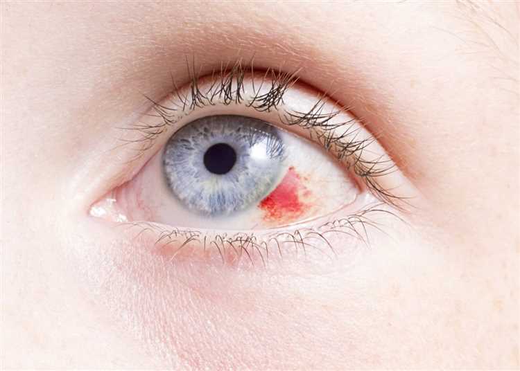 Лечение перенапряжения глаз