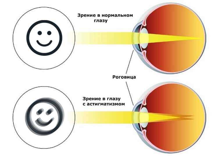 Какие бывают нарушения зрения?